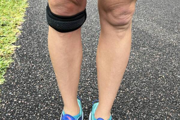 knee-bursitis